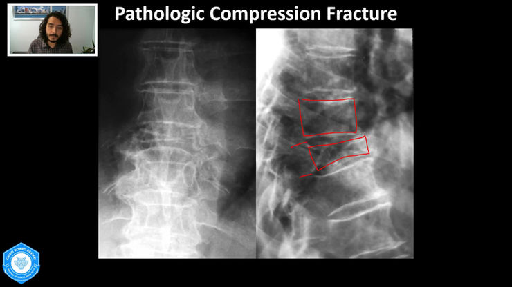 Thoracic Spine